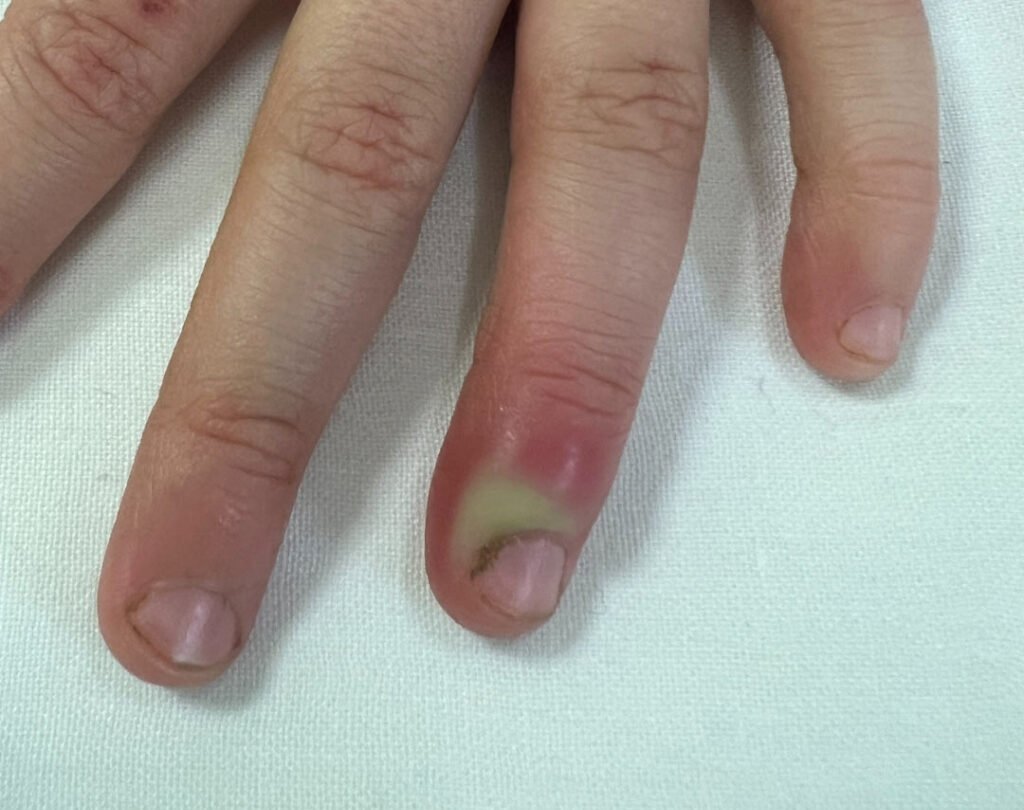 Nail Conditions Treatments at SkinVive in Hyderabad by Dr. Karishni Chittarvu