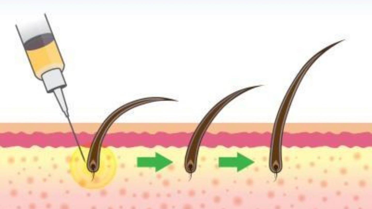 Mesotherapy for Hair at SkinVive in Hyderabad by Dr. Karishni Chittarvu